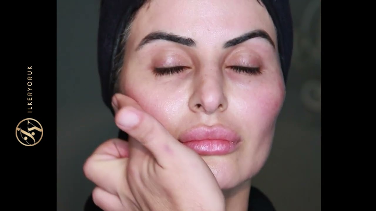 Radiesse calcium hydroxiapatit ile cilt gençleştirme ve yüz liftingi